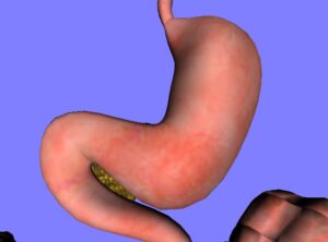 stomach gas