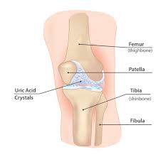 uric acid